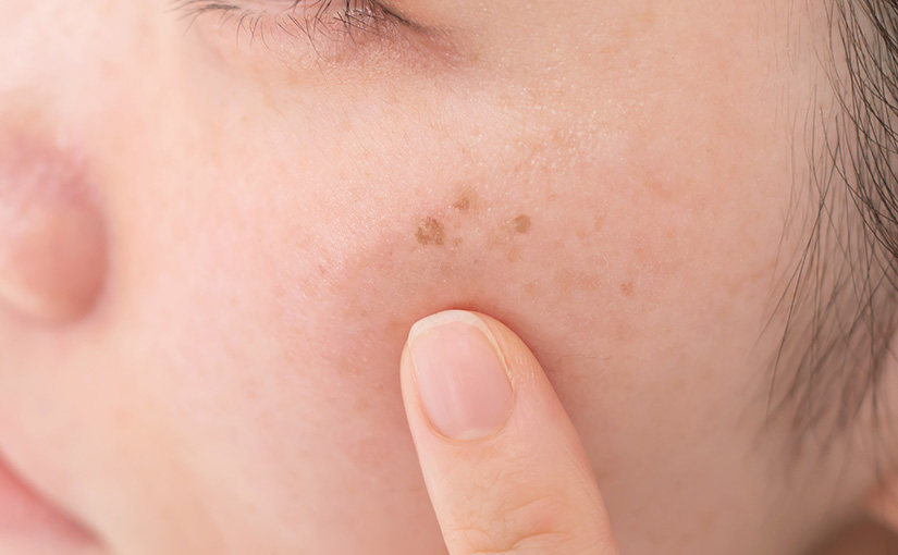 美容外科でも美容皮膚科でも受けられるシミ治療の特徴