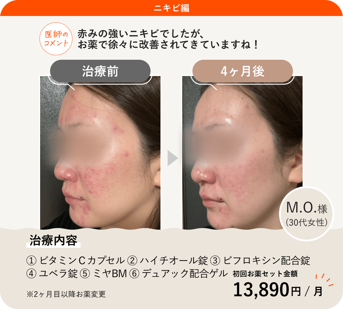 ANS.の治療薬を使ってニキビ治療をした症例紹介