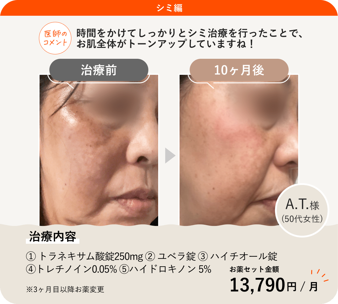 ANS.の治療薬を使ってシミ治療をした症例紹介