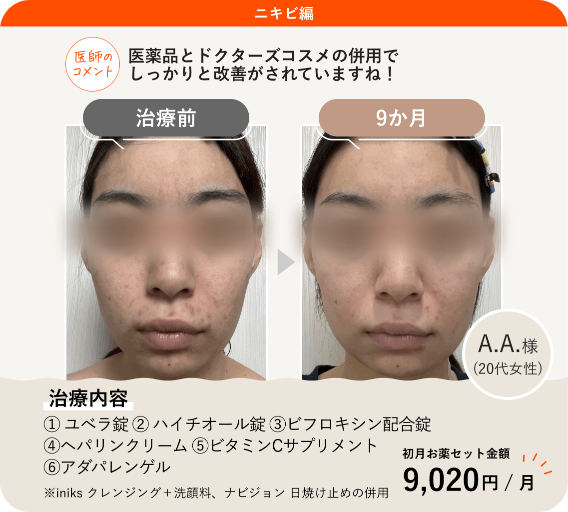 ANS.の治療薬を使ってニキビ治療をした症例紹介