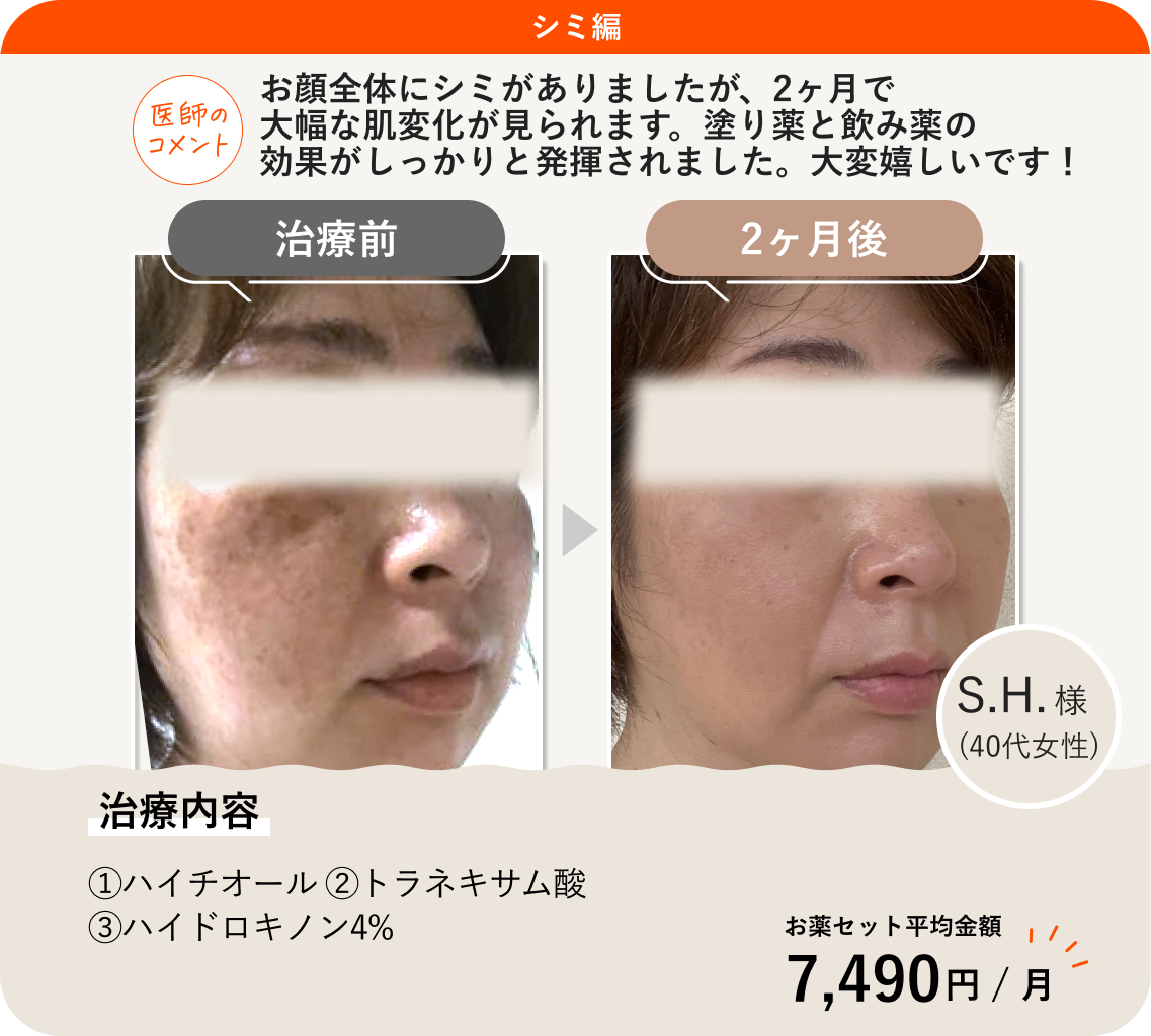 ANS.の治療薬を使って肝斑治療をした症例紹介