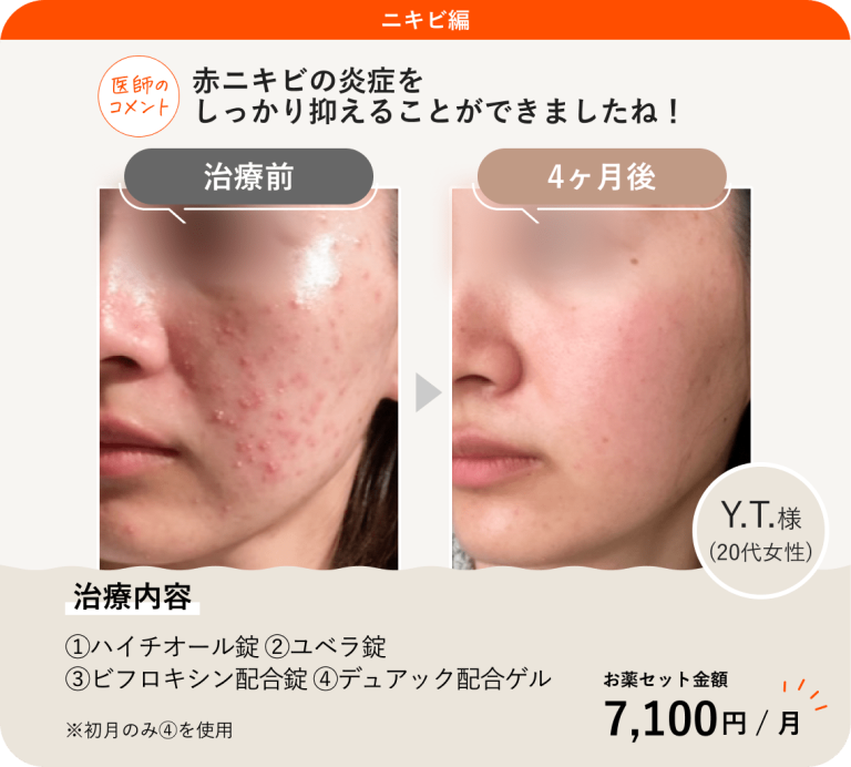 白ニキビを一晩で治す方法はある?正しいケア方法を解説!|ANS. magazine
