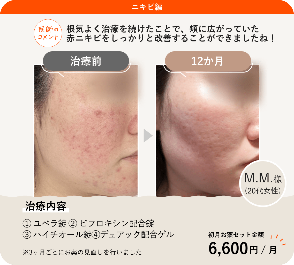 ANS.の治療薬を使って美肌治療をした症例紹介