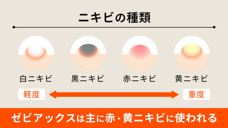 ニキビの種類