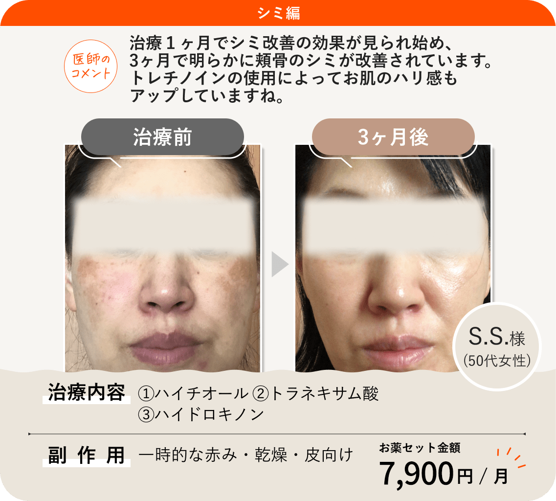 ANS.の治療薬を使って肝斑治療をした症例紹介