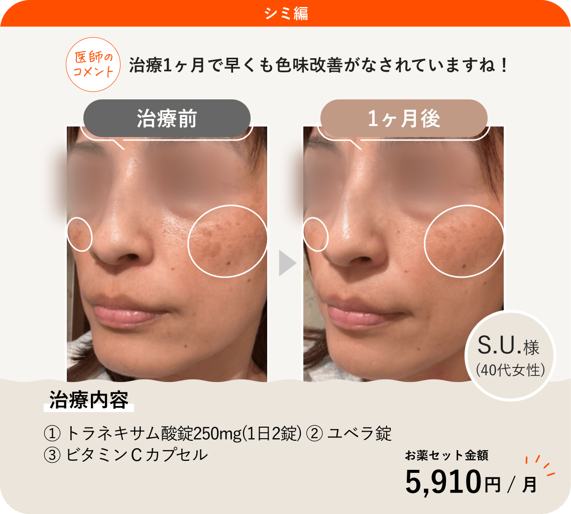 ANS.の治療薬を使ってシミ治療をした症例紹介