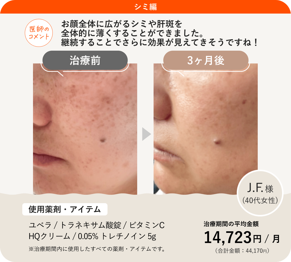 ANS.の治療薬を使ってシミ治療をした症例紹介