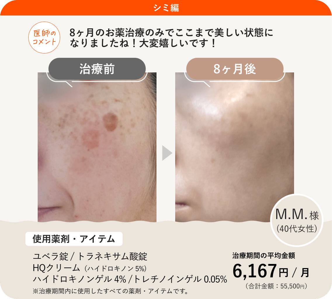 ANS.の治療薬を使ってシミ治療をした症例紹介