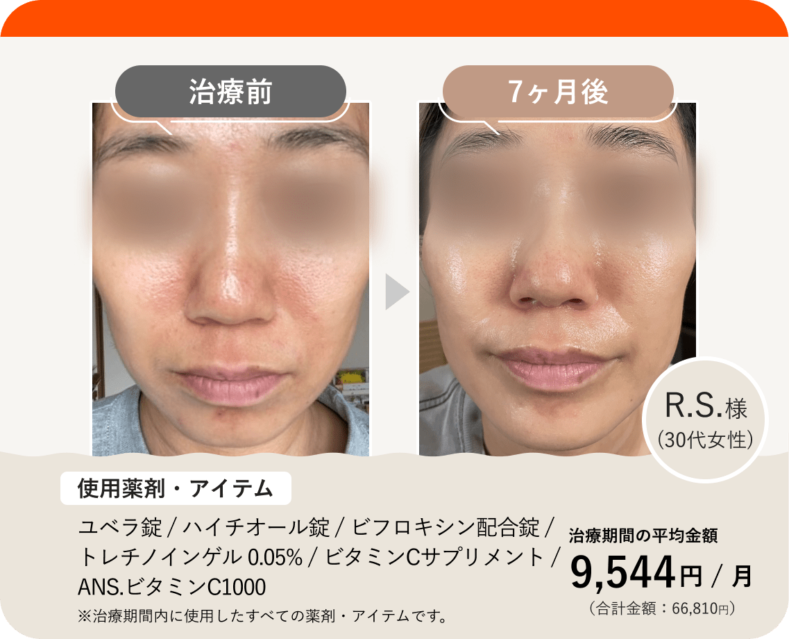 ANS.の治療薬を使って美肌治療をした症例紹介