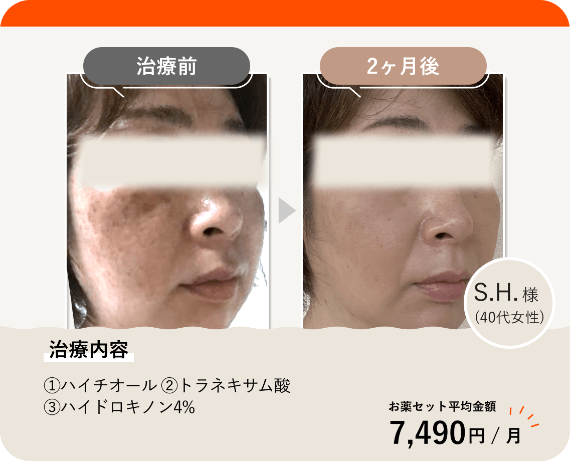 ANS.の治療薬を使って美肌治療をした症例紹介