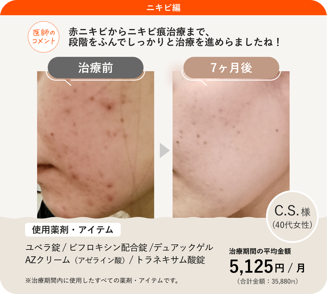 ANS.の治療薬を使ってニキビ治療をした症例紹介