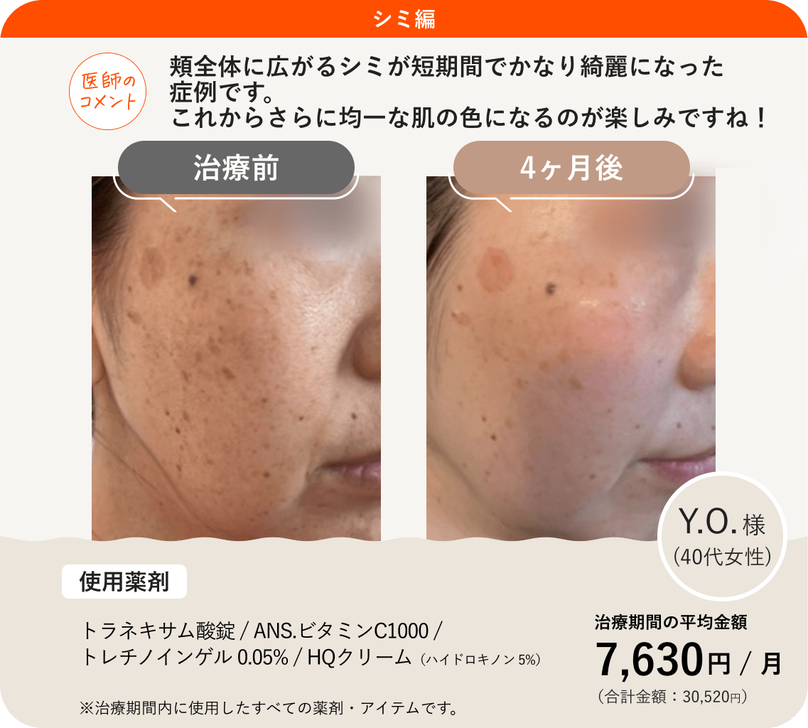 ANS.の治療薬を使ってシミ治療をした症例紹介