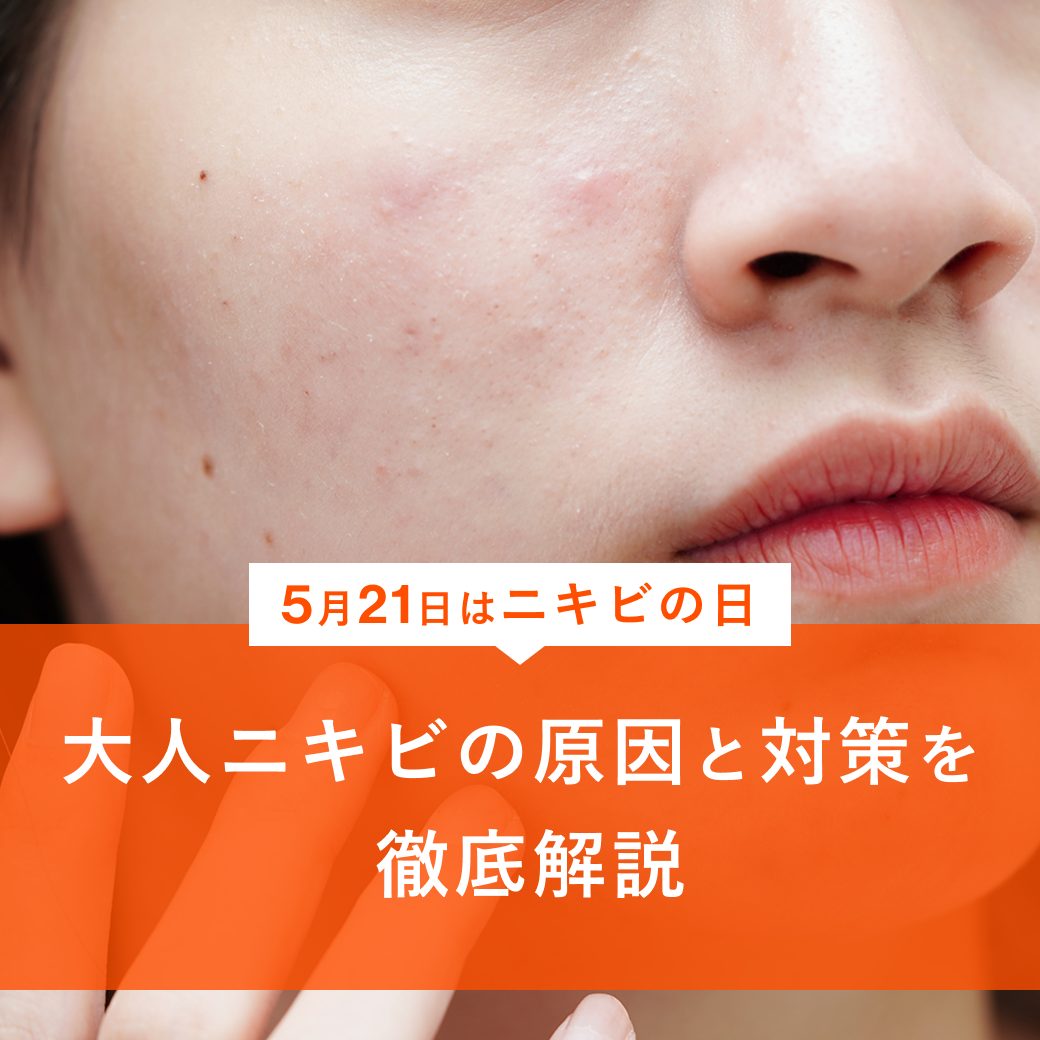 【5月21日はニキビの日】もうニキビケアで失敗しない！大人ニキビの原因と正しい対策について | ANS.医師監修