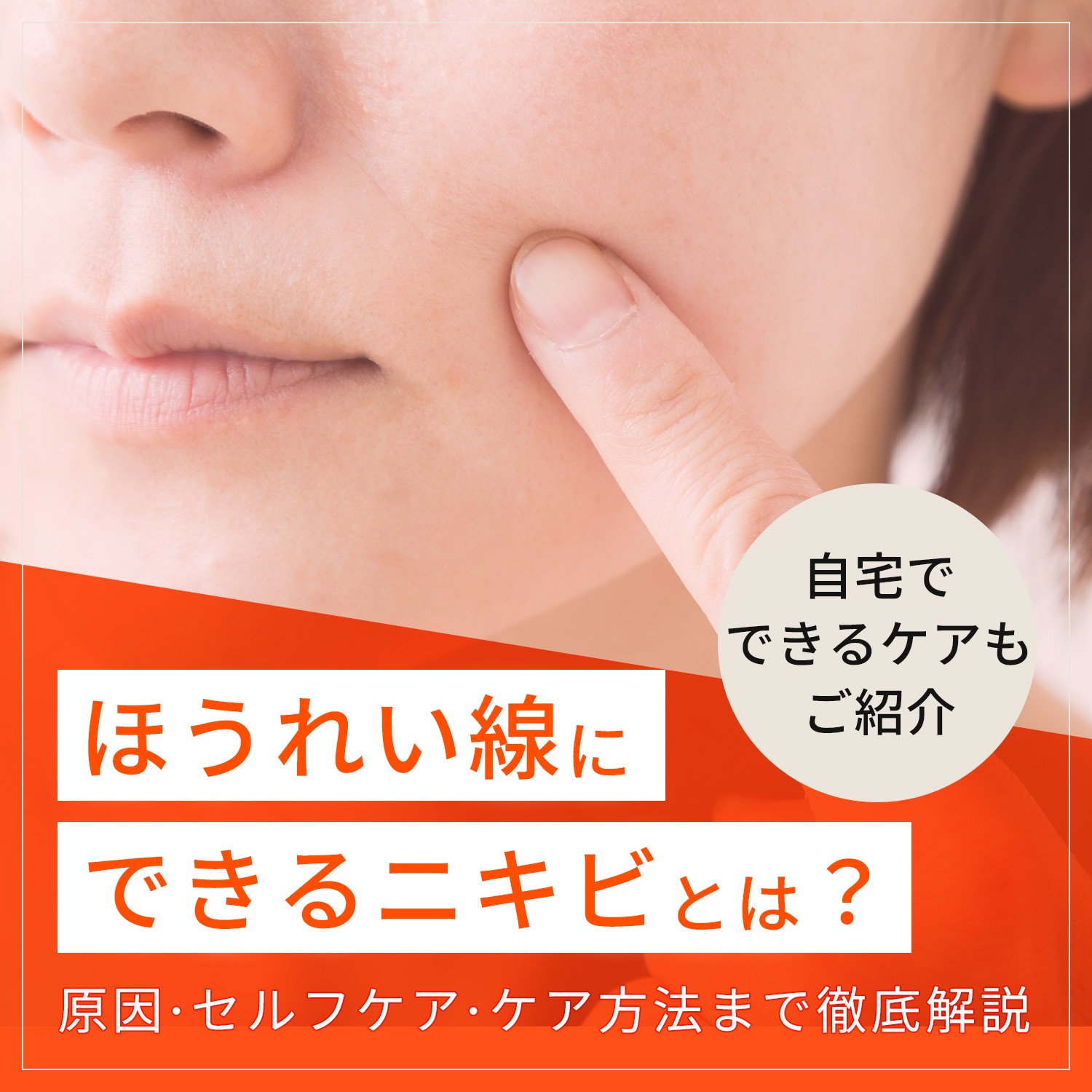 ほうれい線にできるニキビとは？原因やセルフケア、通院不要のケアまで徹底解説