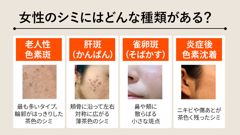 女性のシミにはどんな種類がある？