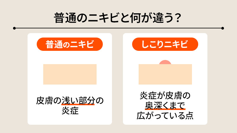 しこりニキビとは？普通のニキビとの違い