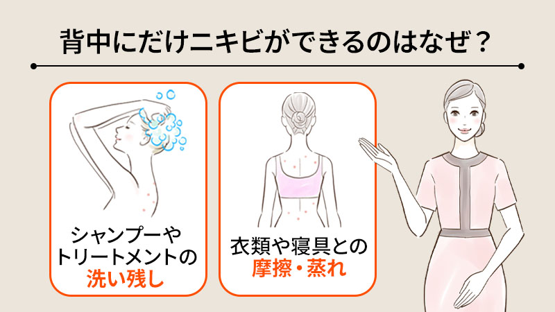 背中にだけニキビができるのはなぜ？背中特有の理由