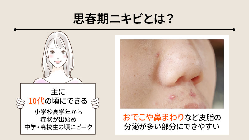 思春期ニキビとは？特徴をわかりやすく解説