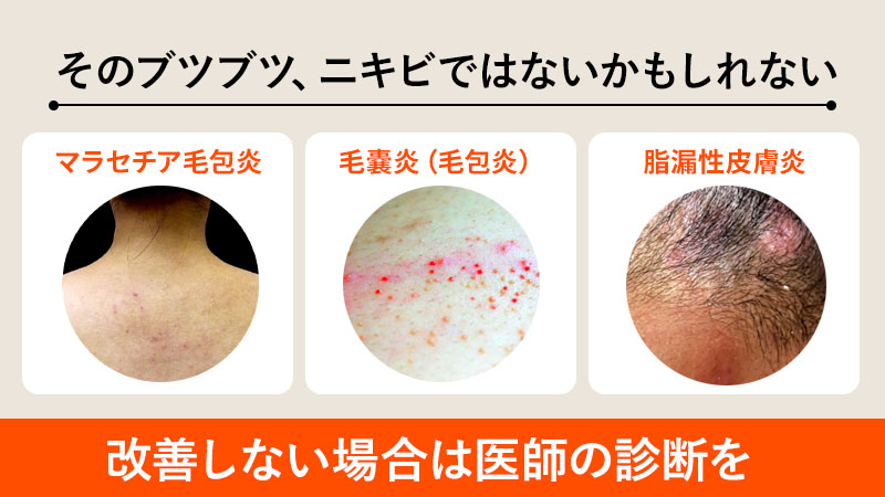 そのブツブツ、ニキビではないかもしれない