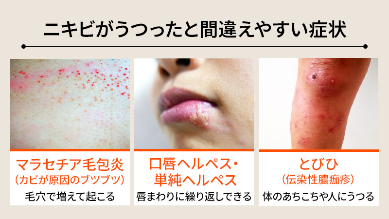 ニキビがうつったと間違えやすい症状