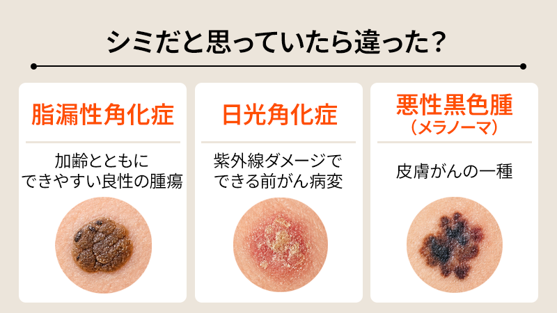 シミだと思っていたら違った？かゆみを伴う皮膚トラブル