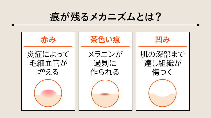 そもそもニキビ痕が残るメカニズムとは？