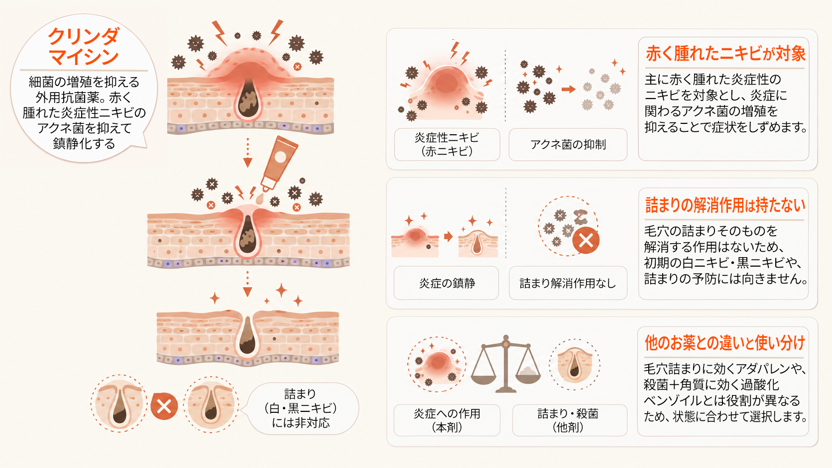 クリンダマイシンが対象とする炎症性ニキビと他剤との役割の違い